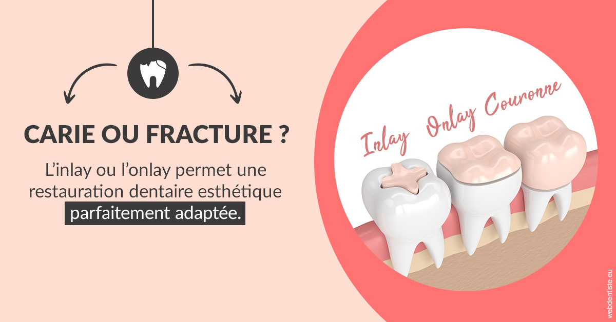 https://dr-jean-de-malbosc.chirurgiens-dentistes.fr/T2 2023 - Carie ou fracture 2