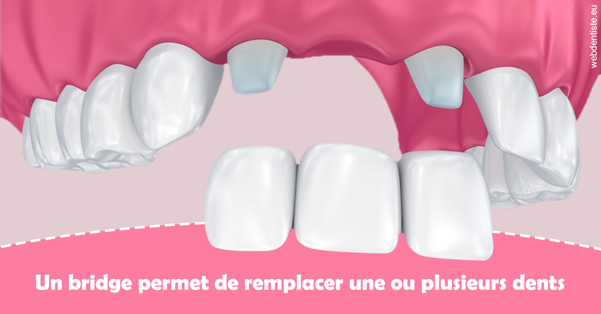 https://dr-jean-de-malbosc.chirurgiens-dentistes.fr/Bridge remplacer dents 2