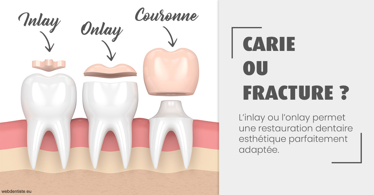 https://dr-jean-de-malbosc.chirurgiens-dentistes.fr/T2 2023 - Carie ou fracture 1