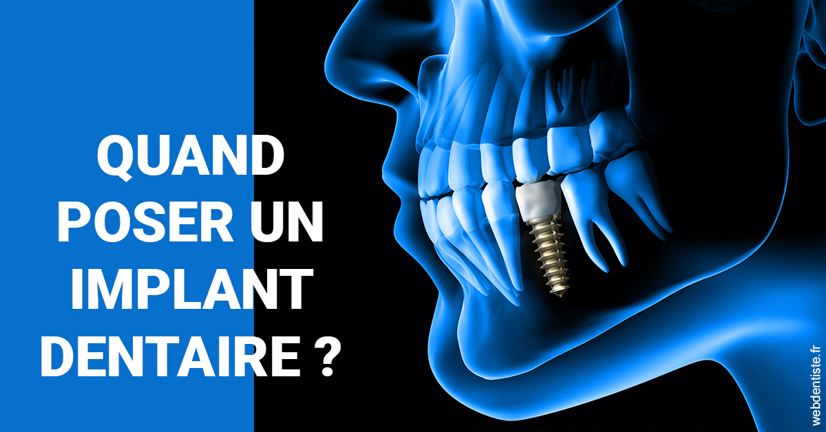 https://dr-jean-de-malbosc.chirurgiens-dentistes.fr/Les implants 1